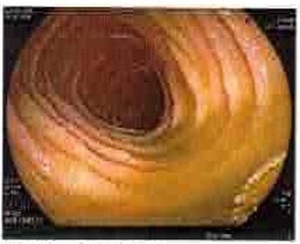 Endoscopic view of the terminal ileum with smooth, healthy mucosa in remission