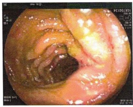 Endoscopic view of the terminal ileum with ulcerated, swollen, friable mucosa